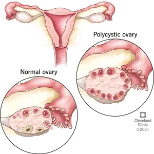 8316-polycystic-ovary-syndrome-pcos 8316-polycystic-ovary-syndrome-pcos