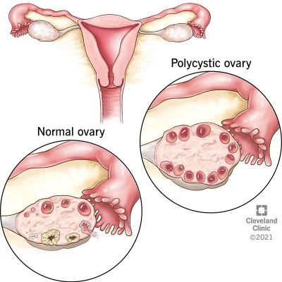 8316-polycystic-ovary-syndrome-pcos 8316-polycystic-ovary-syndrome-pcos
